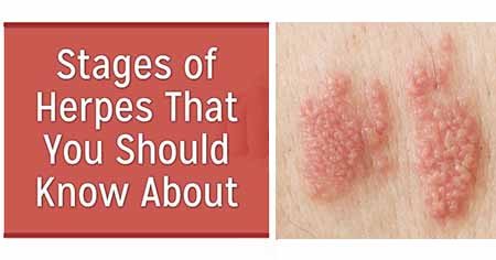 the stages of a herpes outbreak